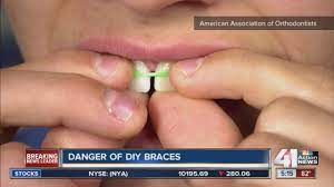 And experts warn it's a bad idea. Diy Braces Youtube