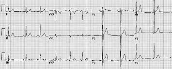 Means her ekg wasnt completely normal (therefore the abnormal), however it was nonspecific meaning it could have. Normal Versus Abnormal Ecg Classification By The Aid Of Deep Learning Intechopen