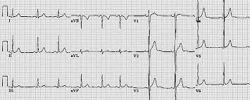 Means her ekg wasnt completely normal (therefore the abnormal), however it was nonspecific meaning it could have. Normal Versus Abnormal Ecg Classification By The Aid Of Deep Learning Intechopen
