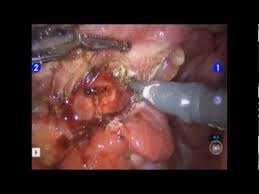 Symptoms include bladder pain and frequent urination. Robotic Surgery For Stage Iv Endometriosis Youtube