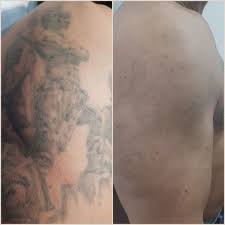 Check spelling or type a new query. Lasser Tattoo Valencia Eliminacion De Tatuajes Valencia Quitar O Eliminar Tatuajes Valencia