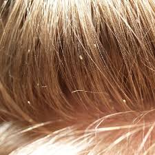 Facts About Head Lice Chambers County
