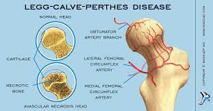 Perthes disease is a rare kind of disability, primarily affecting the hip joint of children. What Is Legg Calve Perthes Disease Mass4d Foot Orthotics