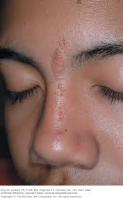 Hale c nevus sebaceus of jadassohn. Epidermal Nevus And Nevus Sebaceous Basicmedical Key