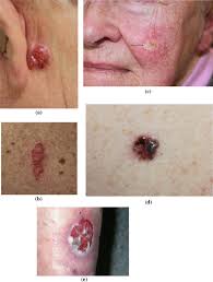 The most common types of cancer associated with lfs include: Recognising Skin Cancer In Primary Care Springerlink