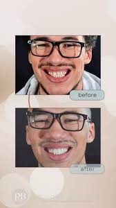 ✨ Transformation Tuesday: From Hiding to Shining! ✨, This incredible young  man came to us feeling self-conscious about his smile due to Enamel  Hypoplasia—a developmental condition that results in ...