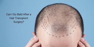 As in any surgical intervention, hair transplantation has its side effects, however, most of them are simply a normal reaction to the treatment and can be managed in case of a shock hair loss, the healthy transplanted strands shed some time after the surgery, normally within the first two months. Hair Restoration Transplant Blog The Youth Fountain In Freehold Nj