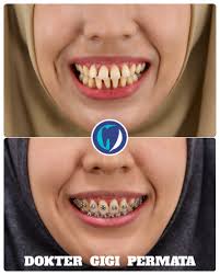 Halo Guys 🙋🙋‍♀️... Ini dia hasil Progress perawatan dari salah satu  #doktergigispesialisortodonti atau #ortodontis kita ... Jadi rapih banget  ya guys 😍🥰😘... Kamu juga bisa kok giginya dirapihin jadi seperti ini,  APALAGI !