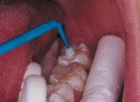 ã€ŒPit and Fissure Sealã€çš„åœ–ç‰‡æœå°‹çµæžœ