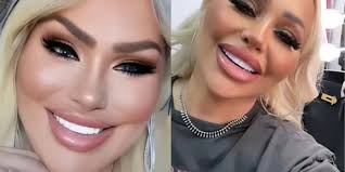 OMG!!! Stacey Silva's Latest Cosmetic Procedure Is Terrifying