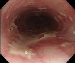 Cmv esophagitis usually affects immunosuppressed or immunodeficient people. Cmv Esophagitis Sequelae Of Radiation Therapy Springerlink