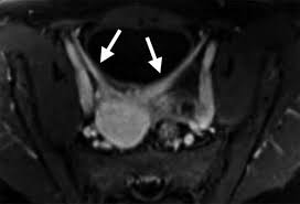 To compare the performance of magnetic resonance imaging (mri) and transvaginal ultrasound (tvu) in detecting deep infiltrating endometriosis (die), using enzian classification. Mr Imaging In Deep Pelvic Endometriosis A Pictorial Essay Radiographics
