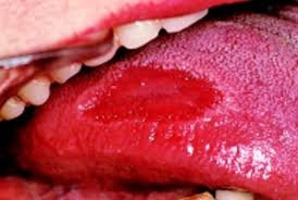 Image result for mouth ulcer on tongue)