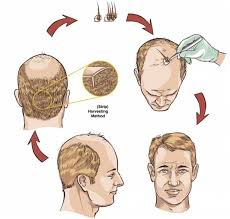 Zakar rafiq, a member of ishrs, is one of the key surgeons at the facility. Hair Transplant London 10 Best Hair Clinics Clinicspots