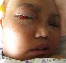 These molds live in soil and in decaying organic matter, such as spoiled foods, leaves, compost piles, or rotten wood. First Case Of Rhinocerebral Mucormycosis Caused By Lichtheimia Ornata With A Review Of Lichtheimia Infections Springerlink
