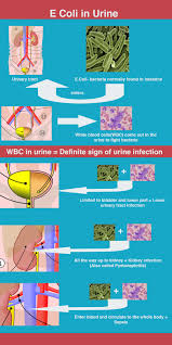Coli) bacteria live in the intestines of people and animals, and are key to a healthy intestinal tract. E Coli In Urine Symptoms And Diagnosis Urinary Tract Infection Remedies Urinary Tract Infection Urinal