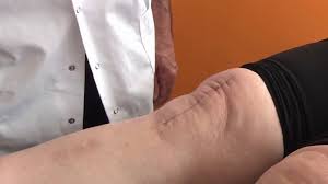 Prothèse totale hanche avec la nouvelle technique. Le Magazine De La Sante Prothese Du Genou Bien Se Preparer A L Operation En Streaming Replay France 5 France Tv