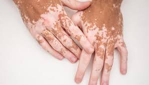 Pigmentation Disorders