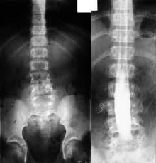 Image result for Spinal Dysraphism