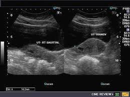 Ultrasound Images Of Early Pregnancy