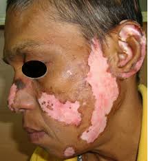 Image result for Photodermatitis