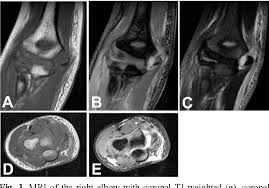 A positive test is indicated by pain over the lateral epicondyle of humerus. Figure 2 From Fracture Of An Unossified Humeral Medial Epicondyle Use Of Magnetic Resonance Imaging For Diagnosis Semantic Scholar
