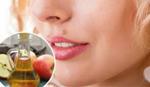Como Eliminar Lunares De Forma Natural Mejor Con Salud
