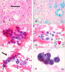 Mucicarmine staining is one stain used by pathologist for detection. Frontiers Cytology Of Primary Salivary Gland Type Tumors Of The Lower Respiratory Tract Report Of 15 Cases And Review Of The Literature Medicine