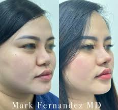 Revision Gore-Tex Rhinoplasty from Threads Lasting, natural, beautiful  results by Mark Fernandez MD No to hiku threads ❌ Because true beauty  deserves mastery, not shortcuts. #getmarked #RhinoplastyExpert