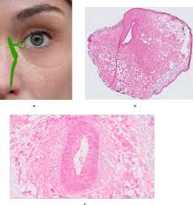 Gesamt waren schon 6722 besucher (22580 hits) hier! Postoncological Lacrimal Duct Reconstruction A Practical Classification System For Reconstructive Planning And Short Term Results Of A Case Series Journal Of Plastic Reconstructive Aesthetic Surgery