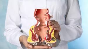 Image result for hemoroid human