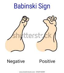 Image result for Babinski Reflex