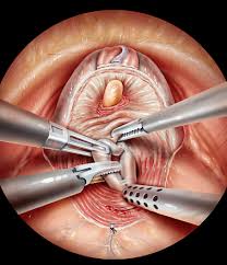 Image result for Radical Prostatectomy