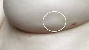 Lumps that feel harder or different from the rest of the breast (or the other breast) or that feel like a change should be checked. Breast Cancer Symptoms What A Breast Dimple Looks Like
