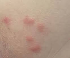 Image result for mite bites on humans