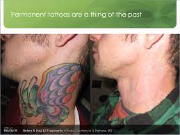 Tattoo removal is now faster and easier. Laser Tattoo Removal Butterfly Medical Spa