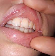 Die lippen gehören zu den empfindlichsten körperteilen. Weiss Jemand Was Diese Schwellung An Der Lippe Ist Gesundheit Medizin Krankheit