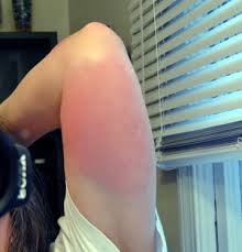 Image result for Fly Bite