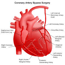 Coronary Artery Bypass Graft Coronary Artery Bypass Graft Surgery Coronary Arteries Coronary Cardiothoracic Surgery