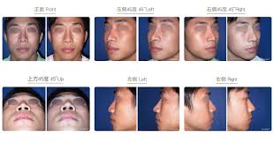 Rarely do we need to remove fat from this area. Nasal Fat Padding Nose Surgery Wish Aesthetic Surgery Clinic