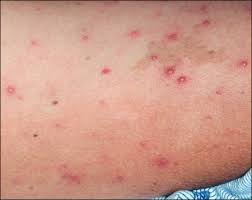 Image result for Generalized Rash