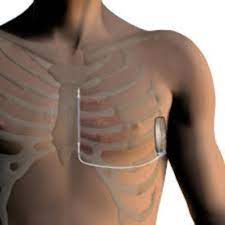 Cartoon esplicativo sulla fibrillazione e sull'efficacia della defibrillazione. Impianto Defibrillatori Impiantabili Sottocutanei S Icd Af Ablation