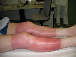 Image result for Skin Trauma