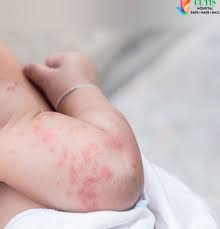 Image result for Papular urticaria
