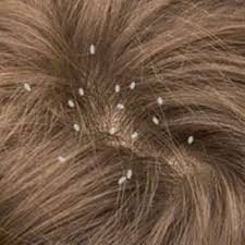 Lice In Hair Home Remedy In Urdu Head Louse Home Remedies For Hair Hair Lice
