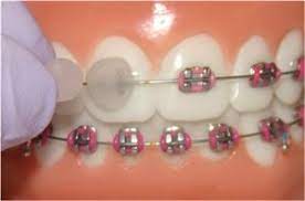 Break off a piece of wax from a candle, and use your hands to roll it into a round ball. Placing Orthodontic Dental Wax Over Brackets Teeth Braces Dental Braces Orthodontics