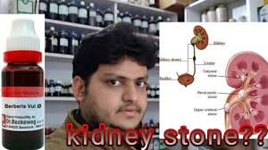 Homeopathic Medicine For Kidney Stone Explain Youtube