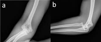 Image result for Radial Head Dislocation