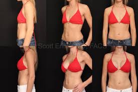 Breast Implant Size Guide In By Ennis Plastic Surgery In