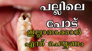 പല ല ല പ ട ഇല ല ത ക ക ന എന ത ച യ യണ Malayalam Health Tips Health Tips Health Tips